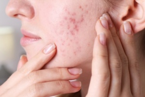 significant-antibacterial-and-acne-treating-effects