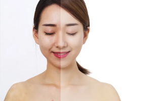 whitening